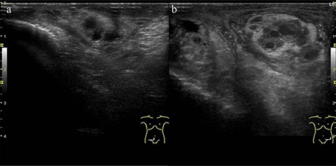 Ultrasound test for his scrotum: (a) right spermatic cord and (b) left spermatic cord. Left spermatic cord was markedly more prominent than the right spermatic cord, with a perineal hyperechoic area.