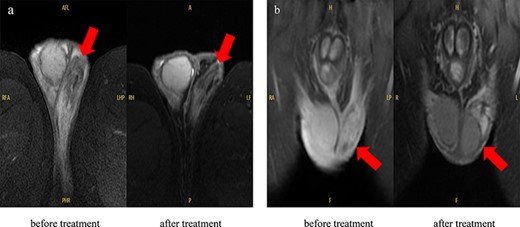 MRI findings in the scrotum: (a) T2-weighted MRI image, which showed enlargement of the left epididymis and dilation of the venous system but improved the size and vasodilation of the epididymis after treatment. (b) Gadolinium-contrasted T1-weighted MRI findings for a sagittal section of the epididymis, which showed soft tissue thickening around the epididymis but improved after treatment.