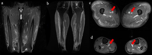 MRI findings for his lower extremities. All images were fat-suppressed T2-weighted MRI findings. (a and c) MRI of femur. (b and d) MRI of lower legs. (a and b) A high intensity area in the adductor femoris, hamstrings, quadriceps, and triceps surae muscles. (c and d) Perivascular high-signal with thickening of the vessel wall was seen in femoral and posterior tibial artery.