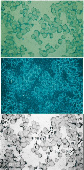  Simultaneous in situ hybridization detection of ET and PR264/SC35 transcripts in CCRF-CEM cells. ( A ) Double labelling observed under direct light plus epipolarized illumination (magnification, ×400) showing the brownish-purple coloration of the alkaline phosphatase precipitate (ET RNA detection) and the light blue gold particles (PR264/SC35 mRNA detection) in the cytoplasm of the cells. ( B ) Double labelling observed under epipolarized illumination only. PR264/SC35 transcripts are visualized by brilliant blue gold particles. ( C ) Laser reproduction of (A) showing examples of different cells which exhibit high levels of PR264/SC35- and ET-specific labelling (PE) or low levels of either PR264/SC35- or ET-specific labelling (pE and Pe, respectively). In cells exhibiting large cytosol areas (L), the blue colour of the gold grains appears to be attenuated by the alkaline phosphatase staining (A), as confirmed by the detection of the gold particles with epipolarized light only (B). In other cells containing smaller cytoplasmic area(s), the blue colour revealed with the combination of the two light sources (A) results from the concentration of gold grains. Since hybridization signals were not normalized, the amount of gold grains and the intensity of the brownish-purple coloration of the alkaline phosphatase precipitate cannot be compared. Control slides do not show the presence of endogenous phosphatase (data not shown). Positive and negative hybridization controls were checked with sense- and antisense-specific GAPDH probes (data not shown). 