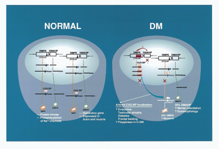 Processing of DMPK and DMAHP genes within normal and DM cells. In the normal cell, the two DMPK genes are both transcribed, the RNAs processed in the nucleus and transported to the cytoplasm where they are bound by specific RNA binding proteins (CUG-BP), and then translated into the DM protein kinase (DMPK). DMPK has been shown to phosphorylate muscle-specific, voltage-gated sodium channels, and in this way may regulate the excitability of the muscle cell. Centromeric to the DMPK gene is the DMAHP gene. The DMAHP gene contains a homeobox domain and it is expressed in brain and muscle during development and through childhood. The presence of the homeobox domain suggests a possible role of this gene in early pattern establishment. In cells from myotonic dystrophy patients (DM), the DMPK gene is transcribed from both normal and mutant alleles but the transcripts are largely retained within the nucleus. Transcripts from the mutant DMPK allele are retained within the nucleus because the expanded number of CUG repeats bind and sequestre mRNA transport proteins (CUG-BP). These proteins are normally cytoplasmic (see ‘normal’), but in patient cells CUG-BP is largely localized within the nucleus, where it may interfere with the processing of other types of mRNAs. This trans-effect on RNA metabolism may lead to different symptoms such as endocrine defects or floppiness in congenital DM. In addition to retaining the cytoplasmic and nuclear transport proteins within the nucleus, the expanded numbers of CTG repeats within the 3′ untranslated region of the DMPK gene interferes with the transcription of the neighbouring DMAHP gene by masking its enhancer that lies within the CTG island. This leads to decreased amount of DMAHP transcript and decreased amount of DMAHP protein. Haploinsuffiency of the DMAHP protein might be responsible for the signs of dysmorphology and mental retardation in DM patients. Finally, the altered RNA metabolism of both the mutant and normal DMPK RNA transcripts leads to deficiency of the DMPK protein (<20%), which could lead to changes in phosphorylation of proteins, and symptoms such as myotonia.