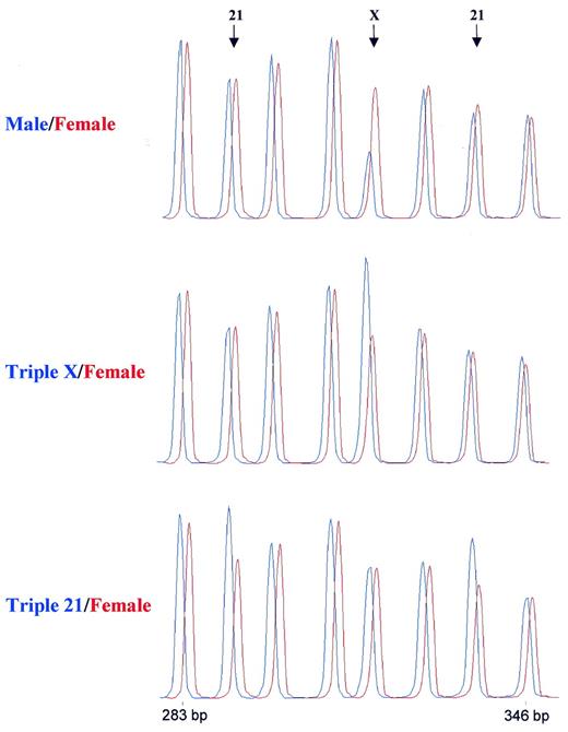 Figure 4. Detection of trisomies by MLPA. Samples containing 100 ng DNA were analysed by MLPA using probe mix P001. Male and female control DNA was obtained from Promega. Blood-derived DNA from a triple X and a female triple 21 individual were provided by the Department of Clinical Genetics, Free University of Amsterdam. Reactions were analysed by capillary electrophoresis (Beckman CEQ2000). In each case the female control DNA is shown in red. Probe mix P001 contains 40 probes. Only part of the resulting electropherogram is shown. Arrows indicate the positions of a 292 bp amplification product of a probe specific for the TFF1 gene on chromosome 21, a 319 bp amplification product of a probe specific for the L1CAM gene on the X chromosome and a 337 bp amplification product of a probe specific for the APP gene on chromosome 21. The other probes were specific for chromosome 3 (283 bp), chromosome 18 (301 and 346 bp), chromosome 13 (310 bp) and chromosome 1 (328 bp). A complete list of genes in this probe mix can be found in Table 1. 