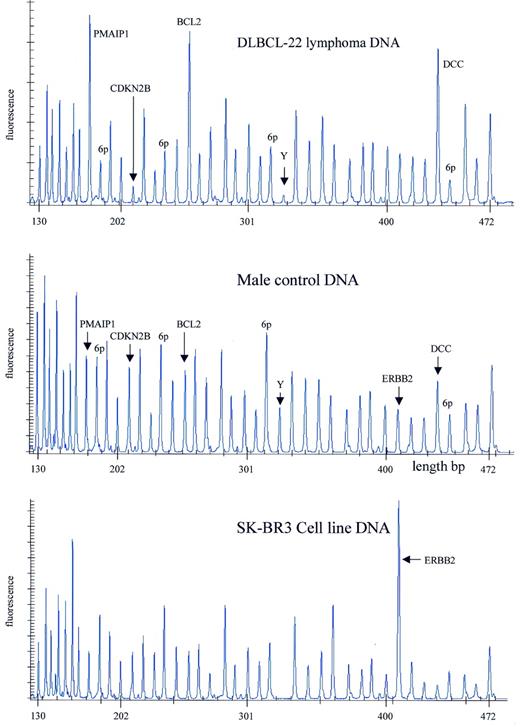 Figure 7. Detection of gains and losses of human chromosomal sequences by MLPA. Samples containing ∼100 ng DNA were analysed by MLPA using probe mix P006. Male control DNA was obtained from Promega. DNA isolated from a frozen DLBCL lymphoma was provided by the Department of Pathology, Amsterdam Medical Center. DNA isolated from the SkBr3 cell line was provided by the Henry Ford Hospital in Detroit. Reactions were analysed by capillary electrophoresis (Beckman CEQ2000). Probe mix P006 contains 41 probes. Probes specific for the chromosome 18 genes PMAIP1, BCL2 and DCC, as well as the CDKN2B gene on chromosome 9 and the ERBB2 gene on chromosome 17 are indicated. A probe recognising the SRY gene on the Y chromosome is indicated by Y. Four probes recognising the KIAA0170, BAK1, TNF and IER3 genes, all in the HLA region of chromosome 6, are indicated by 6p. The exact gene, sequence and chromosomal location recognised by each probe of the P006 probe mix can be found at the www.mrc-holland.com website. 