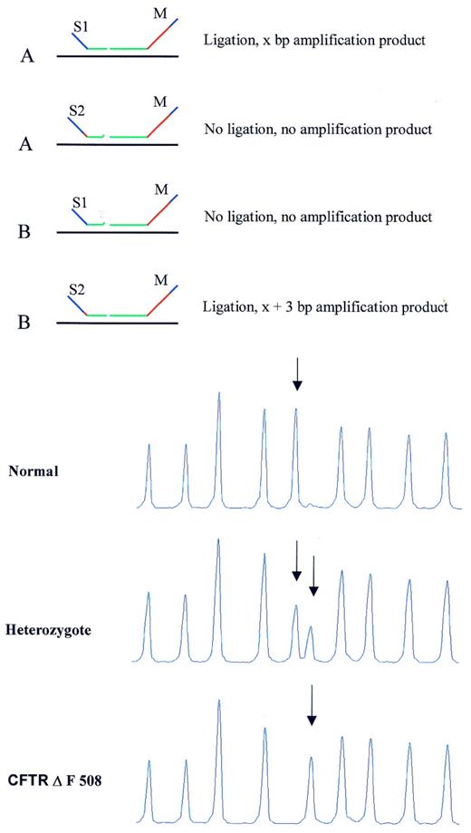 Figure 8. MLPA analysis of SNPs/mutations resulting in amplification products for both alleles with different lengths. (Top) Schematic drawing. Target sequences A and B differ in 1 nt. The short synthetic probe oligonucleotides S1 and S2 differ also in 1 nt, each being specific for one SNP sequence. In addition, S1 and S2 differ in length due to the presence of a 3 nt stuffer sequence between the hybridising sequence and the PCR primer sequence of oligonucleotide S2. Both oligonucleotides can anneal to target sequences A and B and will compete with each other for binding. A mismatch adjacent to the ligation site, prevents oligonucleotide ligation to the common M13-derived probe oligonucleotide M when S1 is bound to B, or when S2 is bound to target sequence A. (Bottom) Capillary electrophoresis profile. Detection of the CFTR ΔF508 mutation by MLPA. DNA samples (100 ng) of a control individual, a heterozygote and a homozygote carrier of the CFTR ΔF508 mutation (3 nt deletion) were tested by MLPA. The probe mix contained 40 probes including a probe for the wild type CFTR sequence and one specific for this mutation. These two probes have the M13-derived probe oligonucleotide in common. The short synthetic probe oligonucleotides differ at the site of the mutation, which is located at the 3′ end of the oligonucleotide as well as in length. Only part of the capillary electrophoresis profile is shown. Arrows indicate wild type (202 bp) and mutation specific probe (205 bp) amplification products. 