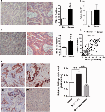 FGF9蛋白在结肠癌中上调，并与HIF-1α水平相关。（A） 左图：代表性图像显示了配对的人类正常结肠组织（Nor）和结肠癌（Ca）中的免疫反应性FGF9蛋白。右：54对正常（Nor）和癌症样本中FGF9阳性细胞的百分比***P<0.0001。（B） 通过RT-qPCR对正常结肠组织（Nor）和结肠癌（n=40）中的FGF9 mRNA进行定量，将其归一化为18S核糖体RNA，并以18S的比率表示。数据表示为平均值±SEM。（C）左：典型图像显示配对的人类正常结肠组织（Nor）和结肠癌（Ca）中的免疫反应性HIF-1α蛋白。右：54对正常（Nor）和癌症样本中HIF-1α阳性细胞的百分比***P<0.0001。（D） 显示正常和癌症样本中FGF9阳性和HIF-1α阳性细胞百分比之间的相关性（n=54）。R=0.758，P<0.0001。（E） 左：代表性图像显示人类结肠癌和肝转移结肠癌细胞中的免疫反应性FGF9蛋白。一： 原发性结肠癌，Ⅱ：原发性结肠癌肝转移；三： 复发性结肠癌肝转移；四： 正常肝脏作为阴性对照，比例尺=100μm。右：癌细胞中相对FGF9蛋白表达（按HIF-1α表达水平标准化）。数据来自3例D期CRC患者，这些患者有原发性肝转移和复发性肝转移的肿瘤组织。结肠：原发性结肠癌，肝转移：原发癌肝转移，肝复发：复发性结肠癌肝转移**P<0.01。