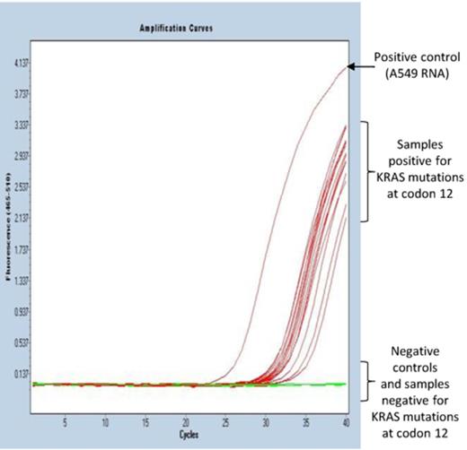 Simultaneous detection of all six possible KRAS mutations at codon 12 in FFPE samples from colorectal cancer patients. Representative qPCR amplification curves of multiplex ExBP-RT assay for detection of KRAS mutations at codon 12 in 44 FFPE samples of colorectal cancer patients.