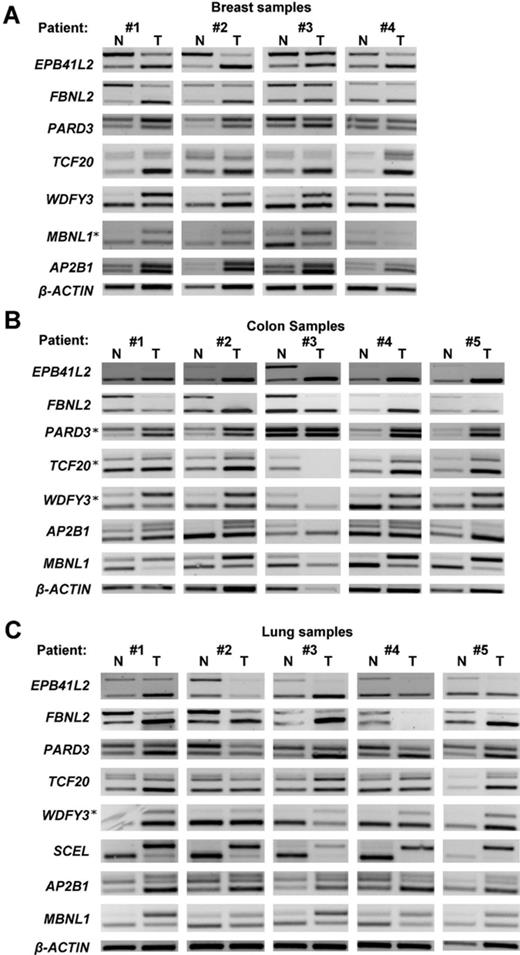 Validation of recurrent alternative splicing changes across patients from three types of cancer. Altered splicing events for genes shown in the figure were examined by RT-PCR analysis. (A) Matched breast tumors and the corresponding normal breast tissue of four breast cancer patients; (B) matched colon tumors and the corresponding normal colon tissue of five colon cancer patients and (C) matched lung tumors and the corresponding normal lung tissue of five lung cancer patients. β-Actin expression is shown as a control for sample recovery and loading. Upper PCR bands, exon inclusion; lower bands, exon exclusion products. Splicing events that were examined in additional cancer type (other than the predicted) are indicated by an asterisk. The predicted pattern of change was observed in most of the samples examined (see Supplementary Table S4 for summary).