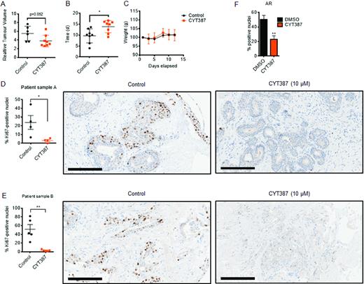 IKBKE inhibition reduces tumour volume and inhibits proliferation of PC ex vivo cultures. CWR22Rv1 cells were implanted subcutaneously in nude mice, and following the development of established xenograft tumours, vehicle (DMSO) (n = 6) or CYT387 100 mg/kg (n = 8) was administered daily by oral gavage. (A) Relative Tumour Volume (compared to dosing day 0) ± SD following either 12 days vehicle or CYT387 treatment. (B) Time for CWR22Rv1 xenografts to reach 4× Relative Tumour Volume (compared to dosing day 0) ±SD following daily vehicle or CYT387 treatment. (C) Mean murine body weight over time, following daily vehicle or CYT387 treatment. (D, E) Ex vivo cultures of two human PC tumours (patient sample A (chTURP); patient sample B (RRP)) were established and treated with either vehicle or IKBKE inhibitor CYT387 (10 μM) for 48 h. Expression of the proliferative marker Ki67 was then assessed in treated explant tissue sections by immunohistochemistry and digitally quantified. Data is expressed as percentage of cells positively stained for Ki67. Representative images of Ki67 staining are shown. Mann–Whitney U test; two-tailed: *P < 0.05, ** P < 0.01. Data points represent the percentage of Ki67-positive nuclei within a representative 40× magnification field, with a total of at least 1000 nuclei analysed for each treatment. Error bars indicate the mean ± SEM. Scale bars = 200 μm. (F) A third ex vivo culture was treated as in D and E but also assessed for AR expression alongside AMACR (cancerous marker) and p63 (benign marker). AR staining was then scored in AMACR positive glands as described above. chTURP, channel transurethral resection of the prostate; RRP, robotic radical prostatectomy.