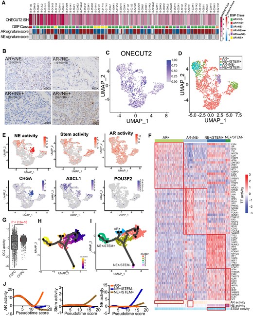 OC2 is expressed in multiple CRPC lineages. (A) RNA scope in-situ hybridization of OC2 on UW-TMA95 series ((8)). NE and AR signature scores were calculated using RNA-seq data and established digital spatial profiling (DSP) class annotation from the matched samples collected from GSE147250. (Refer to methods).(B) Representative IHC staining of OC2 in CRPC specimens in established phenotypes. (C) UMAP plot illustrating OC2-expressing epithelial cells from 6 CRPC patients scRNA-seq datasets selected for further analysis. (D) UMAP plot illustrating OC2-expressing cells annotated to distinct lineages in CRPC. (E) UMAP plots illustrating OC2-expressing cells colored by three lineage signature activities (AR, NE, Stem) and expression levels of representative markers (CHGA, ASCL1 and POU3F2). (F) Unsupervised clustering of OC2 expressing epithelial cells from 6 CRPC scRNA-seq datasets using transcription factor (TF) activity from the high-confidence DoRothEA database. (Refer to methods). (G) CRPC patient samples show higher OC2 activity compared to CSPC patient samples (Refer to methods). (H) UMAP plot showing the pseudotime trajectory of OC2-expressing cells with progression from CSPC (M0 status) cells to CRPC. (I) UMAP plot showing development of three distinct lineages along the pseudotime trajectory. (J) AR, NE and Stem signatures were computed to track the development of three lineages.