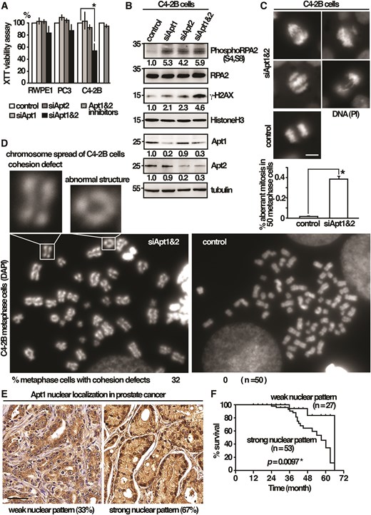 A pro-survival function of Apt1 and Apt2 against mitotic stress in cancer cells. (A) Human cells indicated were subjected to the XTT cell viability assay. Data were expressed as means ± standard deviation in triplicate. Asterisks indicated statistical significance (P < .05, t-test unpaired) versus control. (B) Total lysates of human cells indicated were subjected to western immunoblotting analysis with indicated antibodies. The relative level of protein of interest was indicated beneath each lane. Average of three independent experiments. (C) Fluorescence micrographs showing chromosome segregation defects in C4-2B cells co-depleted of Apt1 and Apt2. Scale bar, 5 μm. Percentage of cells with aberrant mitosis in late anaphase was given (n= 50) in triplicate. (D) Metaphase chromosome spreading assay of C4-2B cells co-depleted Apt1 and Apt2. Examples of premature separation of sister chromatids and abnormal ring-like chromosome structures are shown as indicated. (E) Representative Apt1 immunohistochemical staining of prostate cancer specimens (MPR1005sur prostate tissue microarray, TissurArray.com). Scale bar, 50 μm. (F) Kaplan–Meier curve showed the association between overall survival and Apt1 nuclear localization in 80 patients with malignant prostate cancer. Statistical significance was calculated using the log-rank test.