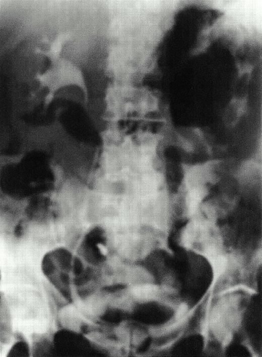 Emphysematous pyelonephritis and pyelitis. IVU shows gas in the left renal parenchyma. Gas is also seen distending the left renal pelvis and outlining the ureter.