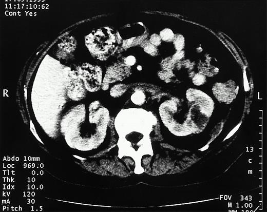 Emphysematous pyelonephritis. CT scan shows typical features of emphysematous pyelonephritis with loculation of gas and diffuse mottling of the parenchyma of the left kidney.