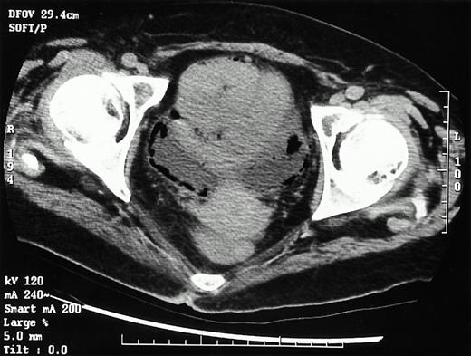 Emphysematous cystitis. CT scan of the lower abdomen and pelvis demonstrating intraluminal and intramural gas in the bladder.