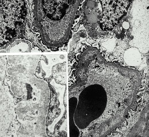 Electron‐microscopic scan of a renal biopsy with glomerular mesangiolysis and peripheral capillary endothelial lesions.