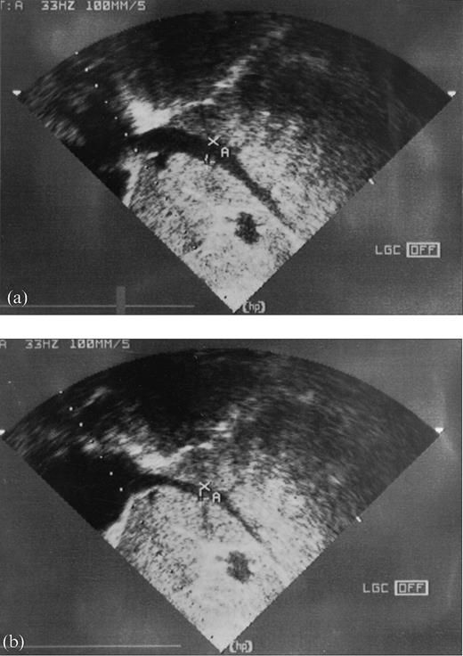 Anterior‐posterior IVCD measured by two‐dimensional and Doppler recording below the diaphragm at inspiration and expiration, (a) before haemodialysis, (b) after haemodialysis.