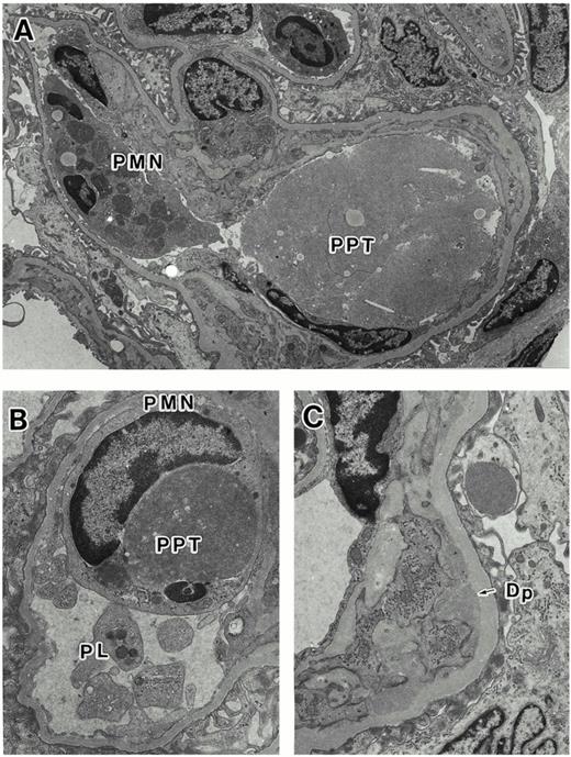 Histologic findings on electron microscopy. (A) The intraluminal precipitates (PPT) and the infiltration of polymorphonuclear cell (PMN) are seen (original magnification ×3790). (B) The polymorphonuclear cells in the capillary lumen showed phagocytic activity against the precipitates (original magnification ×9090). Accumulation of platelets (PL) are seen. (C) Definite mesangial deposits (Dp) are seen (original magnification ×7030).