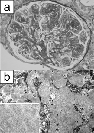 Pathological findings of renal biopsy specimens. (a) Light microscopy. A glomerulus showing membranoproliferative glomerulonephritis with lobular accentuation. Periodic acid–Schiff, original magnification ×400. (b) Electron microscopic examination. Marked mesangial widening is noted with microtubular deposits (original magnification ×10 000). Inset: high power view of microtubular deposits in the mesangial area. Bar = 100 nm (original magnification ×30 000).