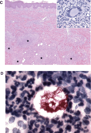(A) Reddish-brown, circumscribed papule on the extremity. (B) Development of an abscess on the posterior thigh. (C) Skin biopsy showing acute panniculitis with abscess formation (asterisk) in the mid-dermis (haematoxylin and eosin stain; magnification: × 2) and (inset) Langhans-type giant cells (haematoxylin and eosin stain; magnification: × 400). (D) Skin biopsy showing rapid-growing acid-fast bacilli (Ziehl–Neelsen stain; magnification: × 600).