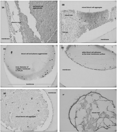 (A–F) Light microscopy pictures of PF capillary membranes of different study groups. (A, SAL-group; B, ALB-group; C, D GEL-group; E and F, HES130-group). Histology made from hollow fibres of PF, formaldehyde fixation, haematoxiline–eosine staining; magnification 400× and 600× (3F), respectively.