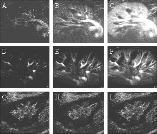  Temporal course of contrast medium wash in. Shown are the first 10 s after the onset of opacification of the interlobar arteries. The examples show a patient with good graft function at times 0 s ( A ), 5 s ( B ), and 10 s ( C ), a patient with slow graft function and graft volume increase due to tissue oedema at times 0 s ( D ), 5 s ( E ) and 10 s, and a patient with severe Banff II vascular rejection ( G ). There was no opacification of the renal cortex after 5 s ( H ) and 10 s ( I ) while there was opacification of the interlobar arteries. 
