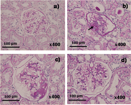Representative glomerular lesions. Glomerular lesions of the rats aged 48 weeks were stained by PAS. The micrograph (a) represents a normal glomerulus in the non-diabetic LETO. A representative glomerulus of the untreated, diabetic OLETF exhibited segmental or global sclerosis [micrograph (b)] and PAS-positive nodular lesions as indicated by an arrow in micrograph (b). Basically, the troglitazone-treated OLETF rats represented glomerular lesions similar to the untreated OLETF as shown in micrograph (c) for the low-dose and in micrograph (d) for the high-dose, but the severity differed between the untreated and troglitazone-treated OLETF.