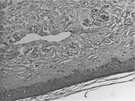 Biopsy specimen of the skin of the right lower leg of patient 1. The thickened dermis demonstrates plumped collagen bundles with surrounding clefts, spindle cellproliferation. Interstitial mucin deposition is frequently present.