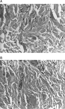 Magnification of skin biopsy shown in figure 1. (A) Fibroblasts and plumped collagen bundles with surrounding clefts. (B) Increased interstitial mucin deposition. (Figures 1 and 2A,B: Haematoxylin and eosin stain).