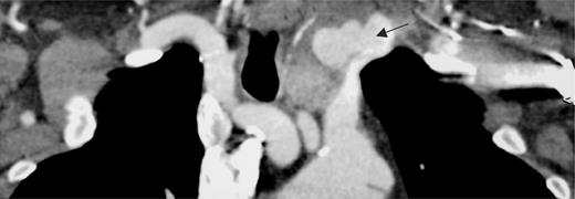 CT scan showing pseudo-aneurysm of left subclavian artery (arrow).