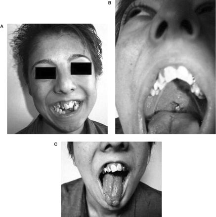 (A) Peculiar face of the patient and tooth abnormalities, (B) cleft palate, (C) lobulated tongue.