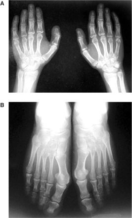 (A) Radiograph of both hands showing short metacarpals and phalanges, (B) radiograph of both feet showing short metatarsals and phalanges. The shortness of the phalanges is more conspicuous than the metatarsals.
