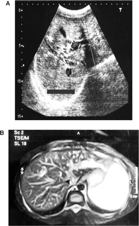 (A) Abdominal ultrasonography revealing tubular and cystic dilatations of intrahepatic bile ducts, (B) magnetic resonance cholangiopancreatography revealing dilated intrahepatic bile ducts with normal extrahepatic bile ducts.