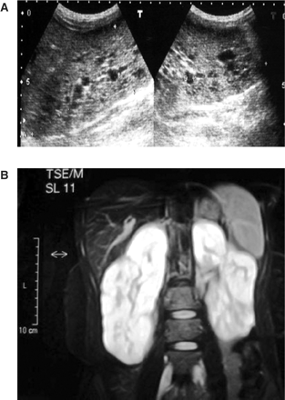 (A) Ultrasonography of kidneys revealing bilateral renal cysts 5–15 mm in size, (B) abdominal MRG revealing bilaterally slightly enlarged kidneys with numerous small cysts in the cortical and medullary sections.