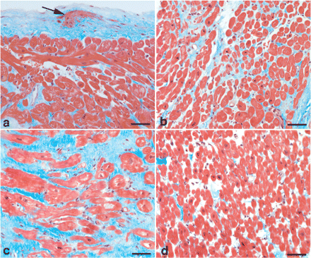 Light micrographs illustrate histopathological changes in endomyocardial biopsies taken from the septal wall of the right ventricle. (a) Increased thickness of endomyocardium and proliferation of subendocardial smooth muscle cells (arrow); (b) region with slight interstitial fibrosis; (c) region with marked interstitial fibrosis and partly hypertrophic cardiomyocytes and (d) region with normal appearance. Sections were stained by Masson trichrome. Bar = 50 µm.