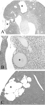 Histopathology of kidney and liver from Pkd2WS25/WS25 and Pkd2+/− mice. (A) Two large cortical cysts are shown in a Pkd2WS25/WS25 mouse with a severe cystic phenotype (20×). (B) A small renal cyst with flattened lining epithelium in the outer medulla of a Pkd2+/− mouse (400×). (C) Multiple liver cysts in a Pkd2+/− mouse (20×). *Indicates the lumen of larger cysts.