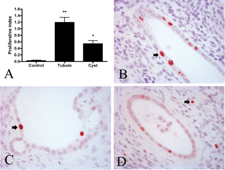 Tubular and cystic cell proliferation in human normal and ADPKD kidney. (A) The PI of control kidneys (n = 10) compared with ADPKD kidneys (n = 16). The PI for cystic kidney was calculated separately for non-cystic tubules and cysts and each was significantly different compared with control values (*P < 0.01, **P < 0.001). Examples of PCNA-positive nuclei (arrows) in a normal tubule (B), a cyst (C) and interstitium (D). Magnification: 400×.