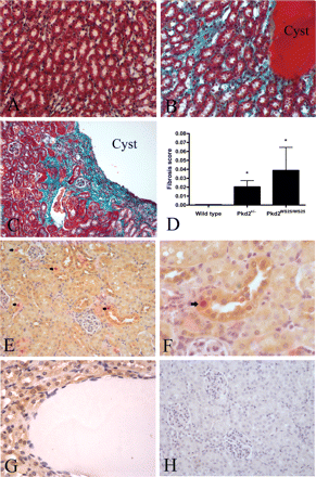 Renal fibrosis in Pkd2 mutant mice (A–D) and localization of PCNA and polycystin-2 in Pkd2+/− kidneys by immunohistochemistry (E–H). Masson Trichrome staining was used to demonstrate the presence of interstitial collagen (green). Cell cytoplasm stains red. (A) Wild-type control kidney showed little fibrosis. (B) Increased renal fibrosis can be seen surrounding a medullary cyst in Pkd2+/− kidney. (C) Severe fibrosis surrounding a large cortical cyst in Pkd2WS25/WS25 kidney. (D) Fibrosis scores for Pkd2+/− (0.0204 ± 0.0069) and Pkd2WS25/WS25 (0.0388 ± 0.0258) kidneys were significantly higher than wild-type controls (0.0006 ± 0.0004) (*P < 0.05 vs control). Magnification: 200×. (E) In Pkd2+/− and normal (not shown) kidneys, polycystin-2 expression (brown) was strongest in the distal convoluted tubules and cortical collecting duct. Several nuclei staining positive for PCNA (red, arrowheads) can also be seen positive for polycystin-2 (brown) (200×). (F) Higher power view of a PCNA-positive cell in a distal tubule showing cytoplasmic polycystin-2 staining (arrow) (400×). (G) An example of a cyst with cyst-lining negative for polycystin-2 staining (400×). (H) No detectable expression in a negative control section (200×).