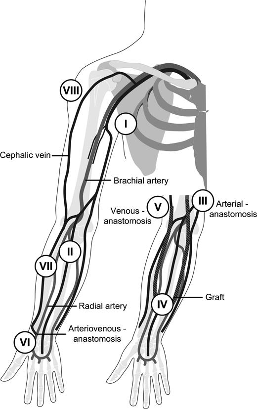 Schematic overview of both access types with the different vascular ...