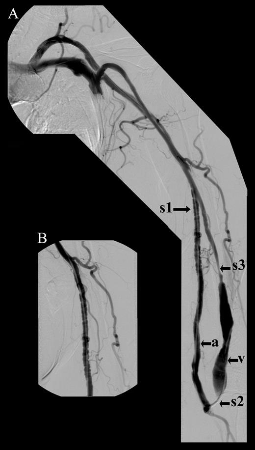 Semicoronal DSA image (obtained by retrograde venous access puncture ...