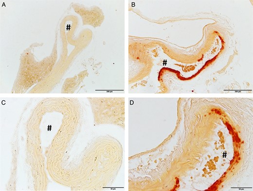 High-phosphate diet induces media calcification in the abdominal aorta, but not in the thoracic aorta. DBA/2 mice fed with a high-phosphate diet for 14 days developed no histopathological signs of arterial calcifications in the thoracic aorta (A and C), whereas there was a clear phenotype of media calcification in the abdominal aorta (B and D). The histopathological evaluation was performed with Alizarin Red stainings. # denotes the aortic lumen. The scale bar measures 200 µm (A, B) and 50 µm (C, D).