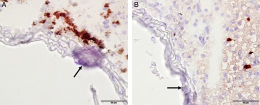 Infiltration of macrophages near foci of media calcification in the abdominal aorta. Immunohistochemical staining of CD68+ macrophages (A) and Ly6G+ neutrophil granulocytes (B) in abdominal aortas of DBA/2 mice after 14 days of treatment with high-phosphate diet. Macrophages accumulated in the Tunica adventitia and infiltrated the Tunica media around established foci of media calcification (arrow).