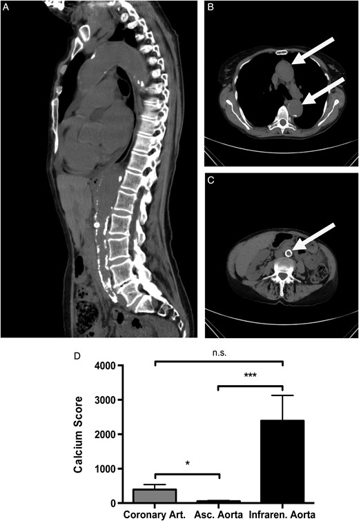 Uraemic media calcification in patients with chronic kidney disease. Representative CT images with a sagittal reconstruction (A) and a transverse section of the thoracic (B) and abdominal aorta (C) are shown in a patient with chronic kidney disease Stage IV (estimated glomerular filtration rate of 28 mL/min/m2) due to hypertensive nephropathy. The white arrow indicates the position of the aorta. (D) In a cohort of 36 in patients with end-stage renal failure, the calcium scores of the ascending aorta (white bar), the coronary (grey bar) and infrarenal aorta with the common iliac arteries (black bar) were measured by native CT scans. The calcium score of the ascending thoracic aorta was significantly lower, when compared with the calcium scores of the abdominal aorta or coronary arteries, respectively. Data are given as means ± SEM. n.s., not significant. * indicates a P-value <0.05, *** indicates a P-value <0.001.
