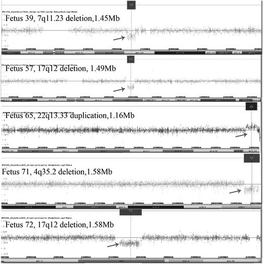 The pathogenic CMA results of our five MCDK fetuses. Fetus 39: CMA revealed a 1.45-Mb deletion spanning genomic position 72701098–74154209 (hg19) at the chromosome 7q11.23 region; Fetus 57: CMA showed a 1.49-Mb deletion spanning genomic position 34822465–36316144 (hg19) at the chromosome 17q12 region; Fetus 65: CMA demonstrated a 1.16-Mb duplication spanning genomic position 49654561–50817492 (hg19) at the chromosome 17q12 region; Fetus 71: CMA detected a 1.57-Mb deletion at the 4q35.2 region (chromosome position: 189380220–19095747, hg19); Fetus 72: CMA revealed a 1.58-Mb deletion at the 17q12 region (chromosome position: 34822465–36404555, hg19).