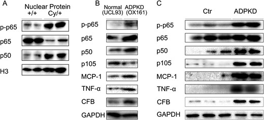 NF-κB pathway is activated in rat PKD and human ADPKD. (A) Expression of p-p65, p65 and p50 in nuclear extracts from fresh rat kidney tissues. (B) Expression of p-p65, p65, p105, p50, TNF-α, MCP-1 and CFB in immortalized human kidney cells (UCL93) and ADPKD cells (OX161). (C) Expression of p-p65, p65, p105, p50, TNF-α, MCP-1 and CFB in control (Ctr) and ADPKD kidney tissues. Blots are representative of three independent experiments.
