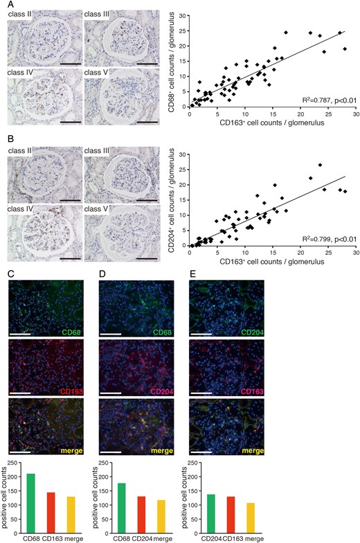 Association between the expression of CD163 and other M2 markers in LN. Glomerular CD68+ (A) and CD204+ (B) macrophages in LN classified according to ISN/RPS criteria (left panels). Bar: 100 µm. Correlations between CD68+ or CD204+ and CD163+ cell numbers in LN glomeruli (right panels) from 62 kidney samples. Coefficients of determination (R2) and P-values are shown. (C–E) Double-immunolabelling of CD68 and CD163 (C), CD68 and CD204 (D), and CD163 and CD204 (E) in LN glomeruli (upper panels). Bar: 100 µm. Quantitative analysis of single cells showing co-localization of markers in more than 30 LN glomeruli (lower panels) from a total of 10 patients.
