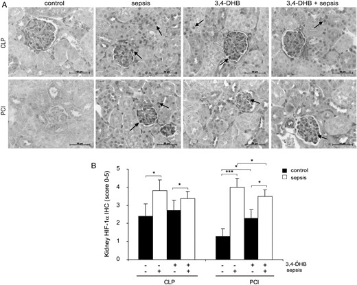 Influence of PHD inhibition on HIF-1α protein expression in murine kidney after sepsis induction. Inhibition of the PHDs was achieved by i.p. administration of 3,4-DHB 4 h prior to sepsis induction. (A) Immunodetection of HIF-1α protein in 4-µm paraffin kidney sections. The staining was analysed using an Axioplan light microscope and Axiovision 4.6 software. Representative images are shown. Scale bars correspond to 50 µm. n = 9–12 kidney sections per treatment. (B) Evaluation of the HIF-1α protein immunostaining in kidney sections by the scoring system. The graph represents the evaluations in every treatment (CLP or PCI) separately without a comparison between the groups. Sepsis induction (*P < 0.05 CLP versus sham-operated mice; ***P < 0.001 PCI versus control) significantly elevated HIF-1α renal expression. The administration of 3,4-DHB in healthy animals increased the basal HIF-1α renal protein (*P < 0.05 versus saline-treated control). CLP and PCI sepsis induced higher HIF-1α protein levels in the kidney and preactivation of HIFs by 3,4-DHB reduced the HIF-1α protein accumulation (*P < 0.05 versus PCI alone).