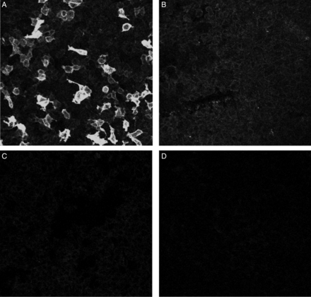Detection of circulating anti-PLA2R using IIF. Serum of PMN patients incubated with HEK293 cells expressing (A1 and B1) and not expressing (A2 and B2) PLA2R protein incubated with sera from anti-PLA2R-positive (A1 and A2) and anti-PLA2R-negative (B1 and B2) cases (all ×20).