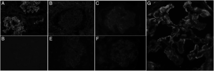 (A) Photomicrograph showing granular staining with PLA2R along glomerular capillary loops in a case of primary MN; (B) glomerular capillary loops are not stained with PLA2R in a case of MN; (C) faint staining with PLA2R in normal kidney podocytes; (D–F) lupus nephritis, IgA nephropathy and MPGN pattern, respectively, showing no glomerular capillary loops staining for PLA2R; (G) granular staining of PLA2R along capillary loops. Immunofluorescence staining, tetramithylrodamine-tagged secondary antibody, ×20 (A–F) and ×40 (G) original magnification.