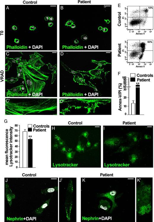 Functional characterization of urinary renal progenitor cell (RPC)-derived podocytes from the patient and controls. (A–D) Distribution of actin filaments by Phalloidin staining in RPC (A and B) and podocytes (C, C′, D, D′) is shown in green. Altered cytoskeleton architecture of podocytes obtained from urinary RPCs of the patient affected by lupus nephritis carrying the risk alleles G1/G2 in APOL1 gene and the genetic variants in NPHS1 gene (D, D′) in comparison with podocytes obtained from a control (C, C′). DAPI counterstains nuclei (white). Bars = 20 µm. Data from one out of five controls are shown. One representative out of four independent experiments is shown. (E) Percentage of dead cells following differentiation into podocytes of u-RPCs obtained from controls (above) and from the patient carrying the risk alleles G1/G2 in APOL1 gene and the genetic variants in NPHS1 gene (below), as assessed by spontaneous uptake of propidium iodide (PI) and annexin V (Annex-V) by flow cytometry analysis. Data from one out of five controls are shown. One representative out of four independent experiments is shown. (F) Graph representing percentage of Annex-V/PI-positive cells in controls (white column) and in the patient (black column), obtained in at least four separate experiments. Data are shown as mean ± SEM. **P < 0.001 by Mann–Whitney Test. (G) Graph representing mean ± SEM of fluorescence intensity of Lysotracker dye in controls (white column) and in the patient (black column). The mean fluorescence intensity was measured per region of interest. One representative out of four independent experiments is shown. **P < 0.001 by Mann–Whitney test. (H and I) Assessment of lysosomal structural integrity by Lysotracker dye (green) in the control (H) and the patient (I). DAPI counterstains nuclei (white). Bars = 20 µm. Data from one out of five controls are shown. One representative out of four independent experiments is shown. (J, J′, K, K′) Expression of nephrin (green) after differentiation into podocytes of RPC obtained from control (J, J′) and the patient carrying genetic variants in NPHS1 gene (K, K′). DAPI counterstains nuclei (white). Bars = 20 µm. Data from one out of five controls are shown. One representative out of four independent experiments is shown.