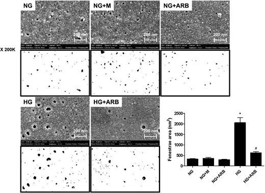 SEM images of GECs exposed to 5.6 mM glucose (NG), NG+24.4 mM mannitol (NG+M), NG+10−7 M L-158,809 (NG+ARB), 30 mM glucose (HG) and HG+ARB. The mean fenestrae size was significantly greater in GECs cultured under HG conditions than in NG cells, and the enlarged fenestrae in HG-stimulated cells were significantly ameliorated by L-158,809 (×200K). *P < 0.001 versus NG, NG+M and NG+ARB groups, #P < 0.01 versus HG group.