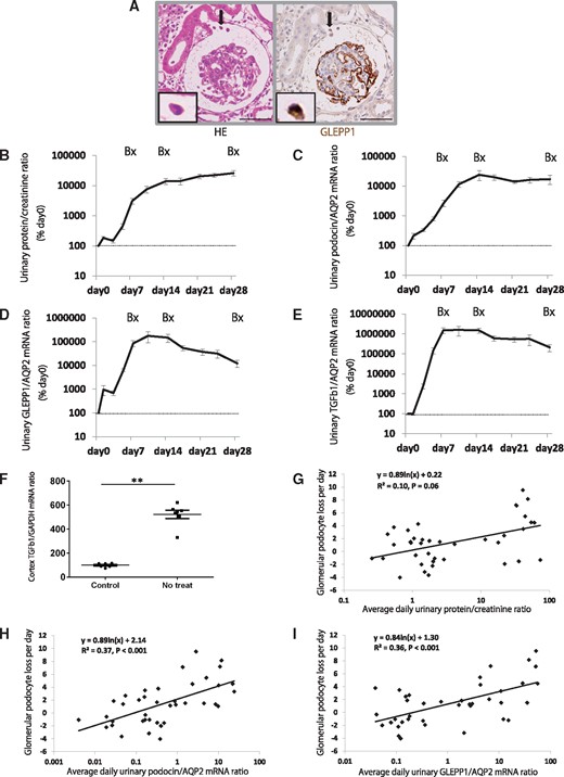 Urinary podocytes and TGF-β1 mRNA for disease progression in a rat model of anti-GBM nephritis. (A) Podocyte detachment from the glomerulus (arrowhead) in the rat model of anti-GBM nephritis. Left panel shows hematoxylin eosin (HE) staining and right panel shows GLEPP1/peroxidase immunostaining (bar = 50 μm). (B) Time course of urine protein:creatinine ratio. (C) Time course of urinary podocin:aquaporin 2 (AQP2) mRNA ratio. (D) Time course of urinary GLEPP1:AQP2 mRNA ratio. (E) Time course of urinary TGF-β1:AQP2 mRNA ratio. (F) Glomerular cortex TGF-β1 mRNA:GAPDH ratio at day 28 after NTS injection. (G) Relationship between glomerular podocyte loss per day (calculated by WT1-positive podocyte nuclear number per glomerular tuft at each time point; days 0, 7, 14 and 28) and average daily urinary protein:creatinine ratio at each time period (days 0–7, days 8–14 and days 15–28). (H) Relationship between glomerular podocyte loss per day and average daily urinary podocin:AQP2 mRNA ratio at each time period. (I) Relationship between glomerular podocyte loss per day and average daily urinary GLEPP1:AQP2 mRNA ratio at each time period. Proteinuria did not quite reach statistical significance (R2 = 0.10, P = 0.06) compared with urinary podocyte mRNA (podocin and GLEPP1) (R2 = 0.37 and R2 = 0.36, P < 0.001 and P < 0.001, respectively). **P < 0.01, assessed using the Mann–Whitney U-test.